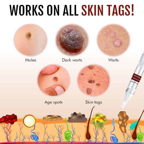 65 Wipeoff Recommends Tags & Moles Remover