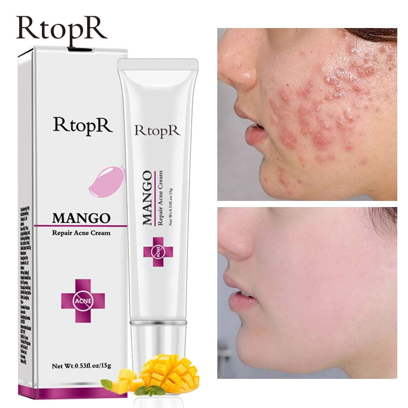 Acne Treatment Face Cream Blackhead Repair Gel Oil Control Shrink Pores Scar Whitening Moisturizer