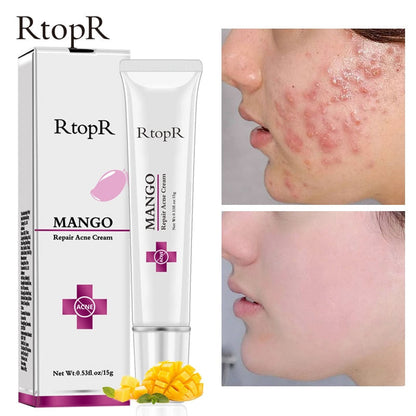 Acne Treatment Face Cream Blackhead Repair Gel Oil Control Shrink Pores Scar Whitening Moisturizer