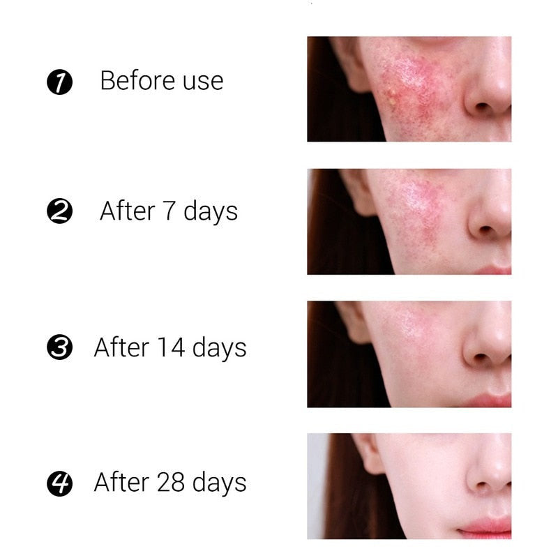 Acne Treatment Face Cream Blackhead Repair Gel Oil Control Shrink Pores Scar Whitening Moisturizer