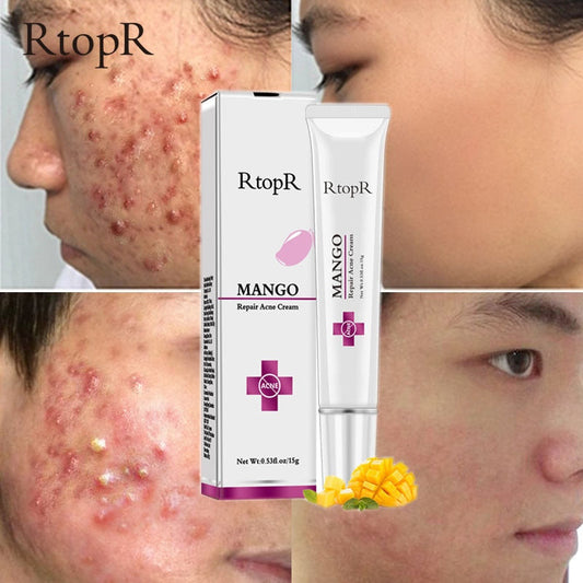 Acne Treatment Face Cream Blackhead Repair Gel Oil Control Shrink Pores Scar Whitening Moisturizer